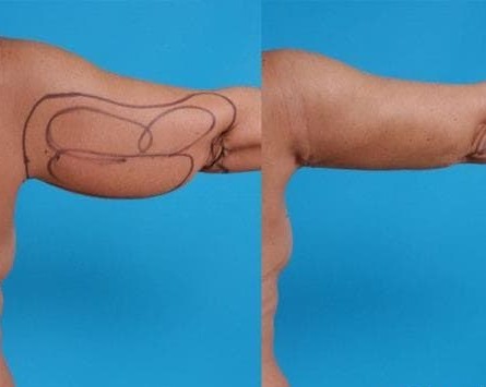 Arm liposuction in Iran