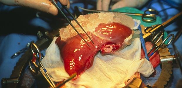 Lebertransplantationschirurgie