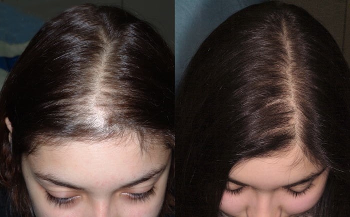 hair transplant for ladies