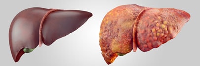 liver transplant in Iran